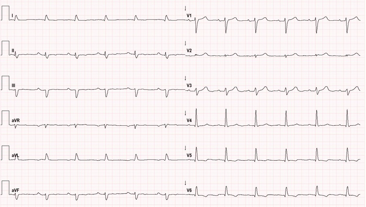 El Hamriti Mustapha (@melhamriti) on Twitter photo Papillary Muscle PVC Ablation <a href="/Phiso_de/">Philipp Sommer</a> <a href="/chris_sohns/">Christian Sohns</a> <a href="/VanessaSciacca_/">Vanessa Sciacca</a> <a href="/MBraunEP/">Martin Braun</a> <a href="/MoneebKhalaph/">Moneeb Khalaph</a> <a href="/steeb_chr/">@ChrSteeb</a> #EnsiteX <a href="/AbbottNews/">Abbott</a> #EPeeps <a href="/AGEP_DGK/">AGEP</a> Papillary Muscle PVC Ablation <a href="/Phiso_de/">Philipp Sommer</a> <a href="/chris_sohns/">Christian Sohns</a> <a href="/VanessaSciacca_/">Vanessa Sciacca</a> <a href="/MBraunEP/">Martin Braun</a> <a href="/MoneebKhalaph/">Moneeb Khalaph</a> <a href="/steeb_chr/">@ChrSteeb</a> #EnsiteX <a href="/AbbottNews/">Abbott</a> #EPeeps <a href="/AGEP_DGK/">AGEP</a>