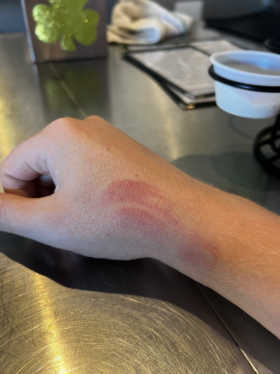 Artnome on Twitter "My airbag burn looks kind of like a lips tattoo."