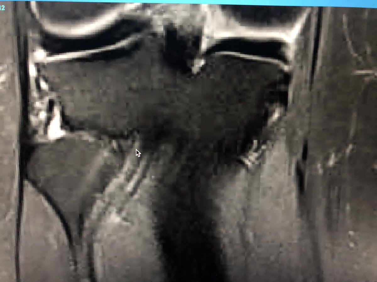 loopielou211's tweet photo. @northwoods1980 Is this a flap tear too? Not commented on in report! https://t.co/ykBzfz8fNN