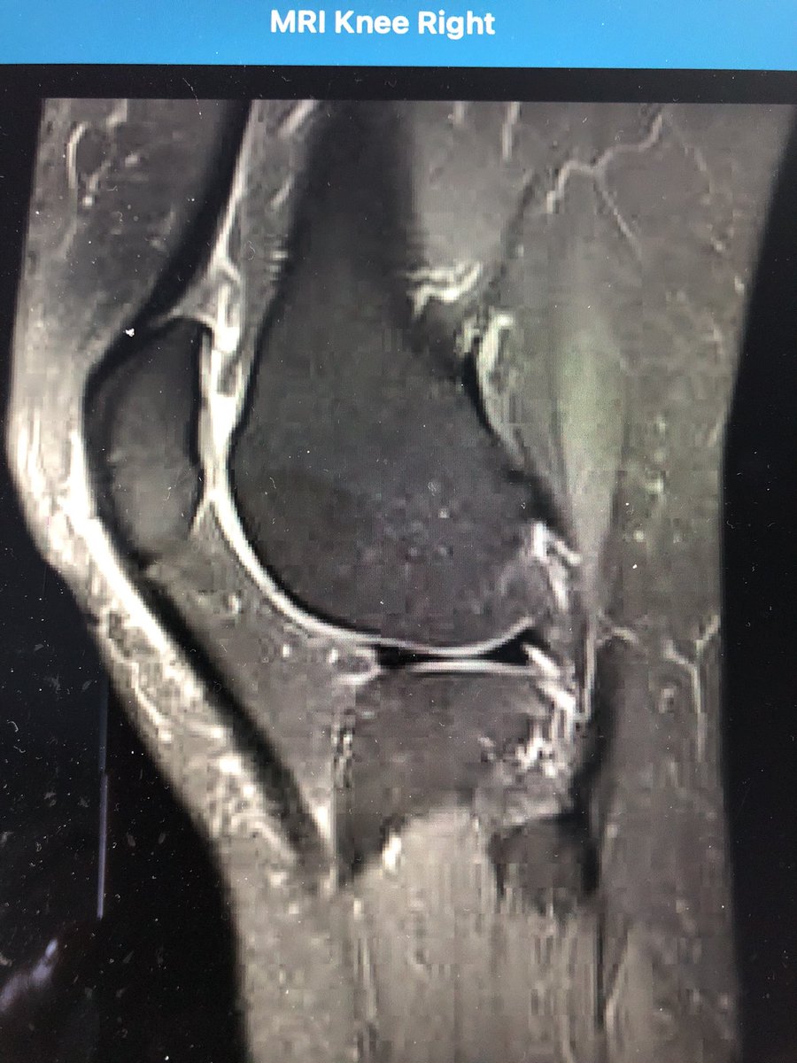loopielou211's tweet photo. @northwoods1980 Is this a flap tear too? Not commented on in report! https://t.co/ykBzfz8fNN