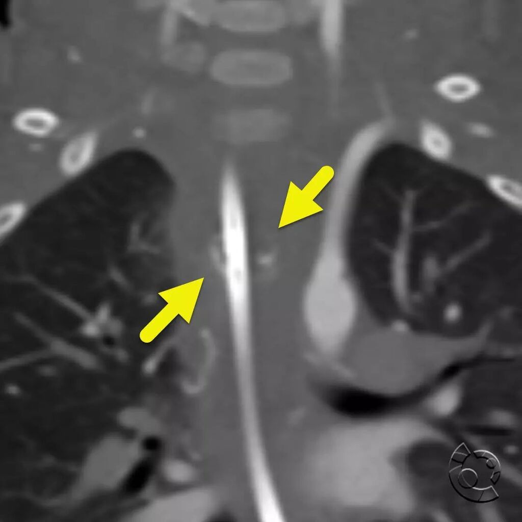 CincyKidsRad's tweet photo. Coronel image from CT angiogram shows metallic residua (arrow) of the button battery. Ingested button batteries are a medical emergency. The battery can conduct a charge across the tissue leading to soft tissue burns. These burns can lead to esophageal i… https://t.co/y3SEdTDi1I https://t.co/MXnPgxJNjK