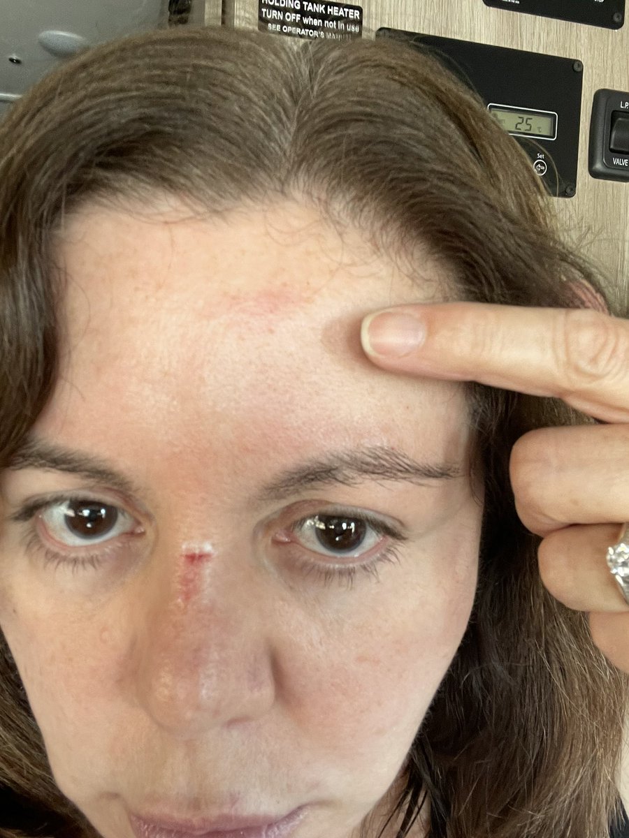 mlbanda's tweet photo. @WinnebagoRVs we just bought a brand new Solis PX. Your cupboard magnet fell on my face creating this injury. You need to recall this problem. #winnebagoRVs #rvwarning https://t.co/eYtwMzWBGL