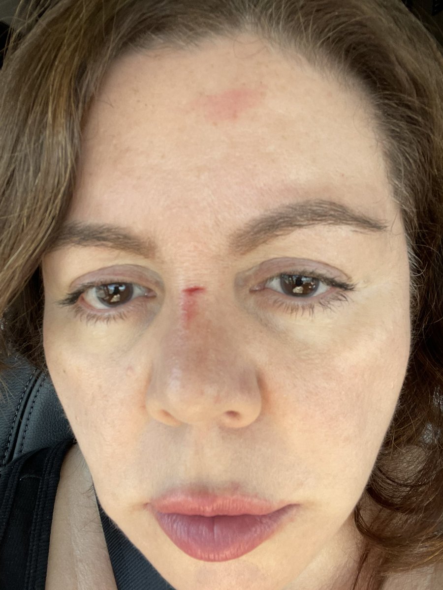 mlbanda's tweet photo. @WinnebagoRVs we just bought a brand new Solis PX. Your cupboard magnet fell on my face creating this injury. You need to recall this problem. #winnebagoRVs #rvwarning https://t.co/eYtwMzWBGL