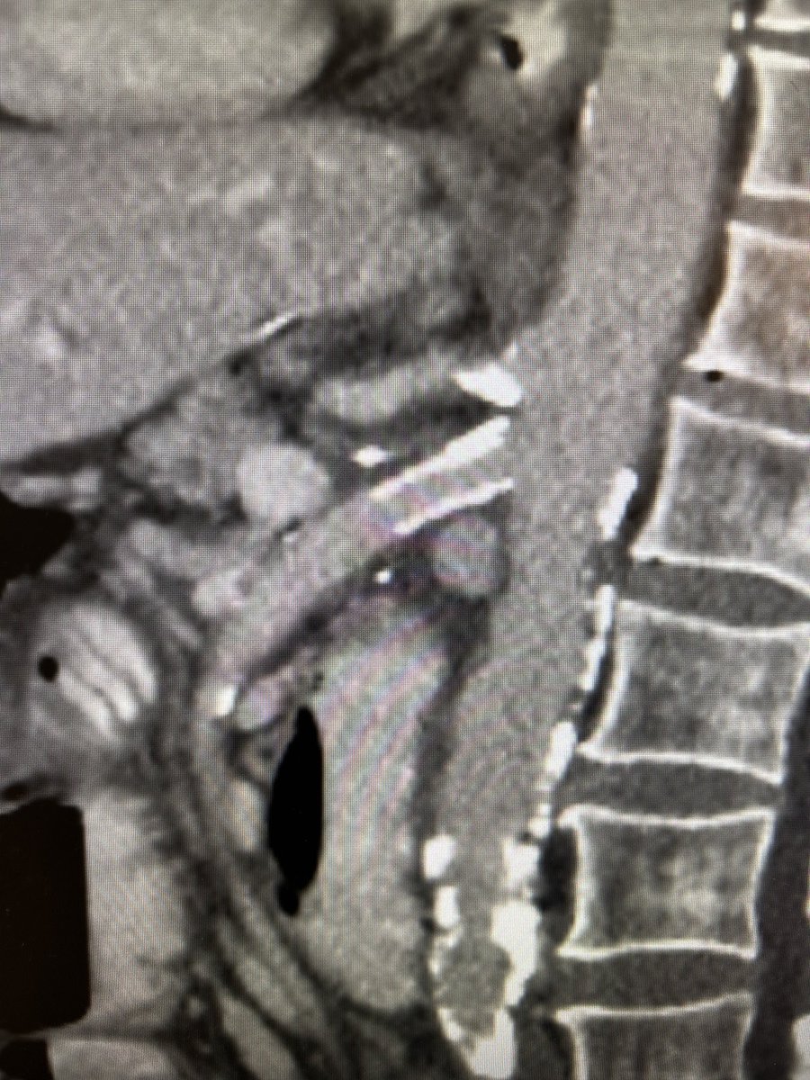 CMI weight loss, patent CA, occluded IMA, s/p total gastrectomy (no supraCA access) with severe calcified/stented iliacs to allow bypass, no problem! Perform SMA endart with retrograde stent. duplex 4yrs later, ⁦@VascularSVS⁩ ⁦@LoyolaSurgery⁩ ⁦@GerardAboodmd⁩