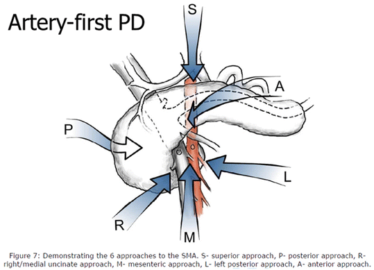 #PDAC - Pancreatic head 6 SMA 1st approaches described and commonly used Sharing the proposed 7th - 'Retromesenteric Approach'. Useful for uninate tomours abuttung SMA from posterior aspect. 1/2 @aamirparray18 @IHPBA @IhpbaIndia @TeamSurgery247 @hpb_so @EAHPBA Video👇