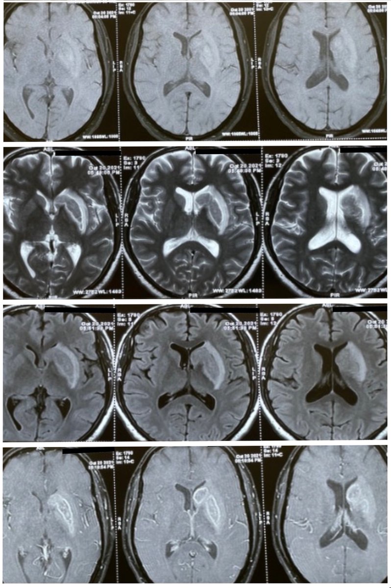 nirmalregency's tweet photo. Our 1st case of Diabetic Striatopathy: Luckily the patient did not go for stereotactic biopsy as he was feeling well. https://t.co/1mcz96nvfz