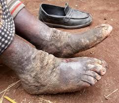 Podoconiosis is a neglected tropical disease (NTD) characterized by lower-leg swelling
(lymphedema),which is caused by long-term exposure to irritant red-clay soils found within tropical
volcanic high-altitude environments with heavy rainfall.
#beatNTDs #WASH
📸 Internet
