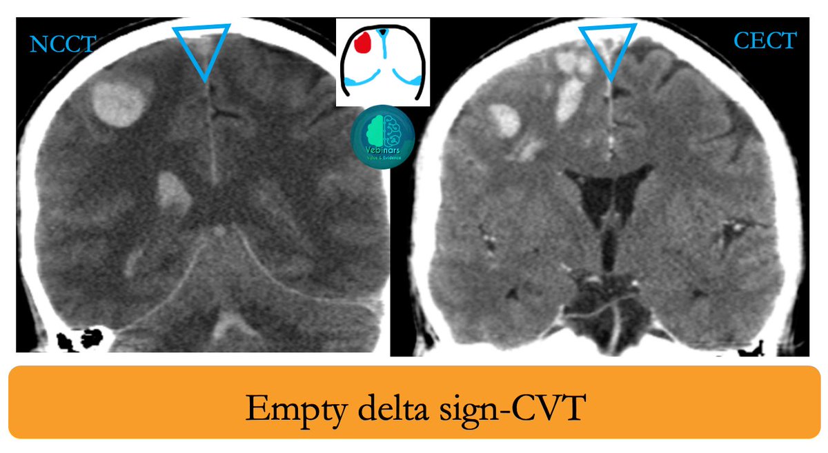 vebinars_neuro's tweet photo. 🧠Spot the stroke -CVT❗️❗️❗️

#vebinars #value_based_imaging #evidence_based_medicine #NeuroRad #Neurology #stroke #FOAMrad #FOAMed #neurotwitter #MedEd #Neurosurgery 
@shriram_shri86 @Meena_chelian https://t.co/XiMDR2h15B