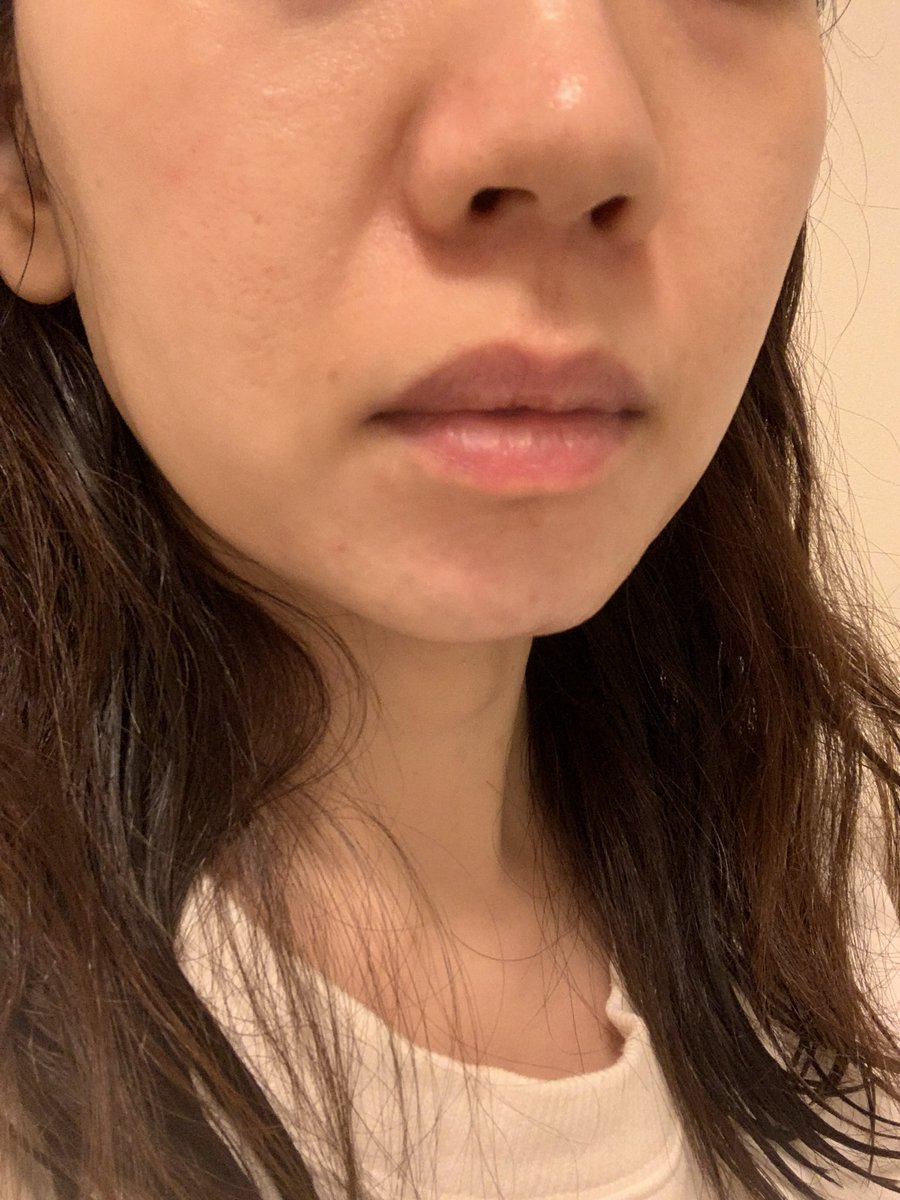 biyo_san's tweet photo. 【fatx coreのダウンタイム】
濃度が濃い分バチバチに腫れた記録

before https://t.co/admj8L5IEo