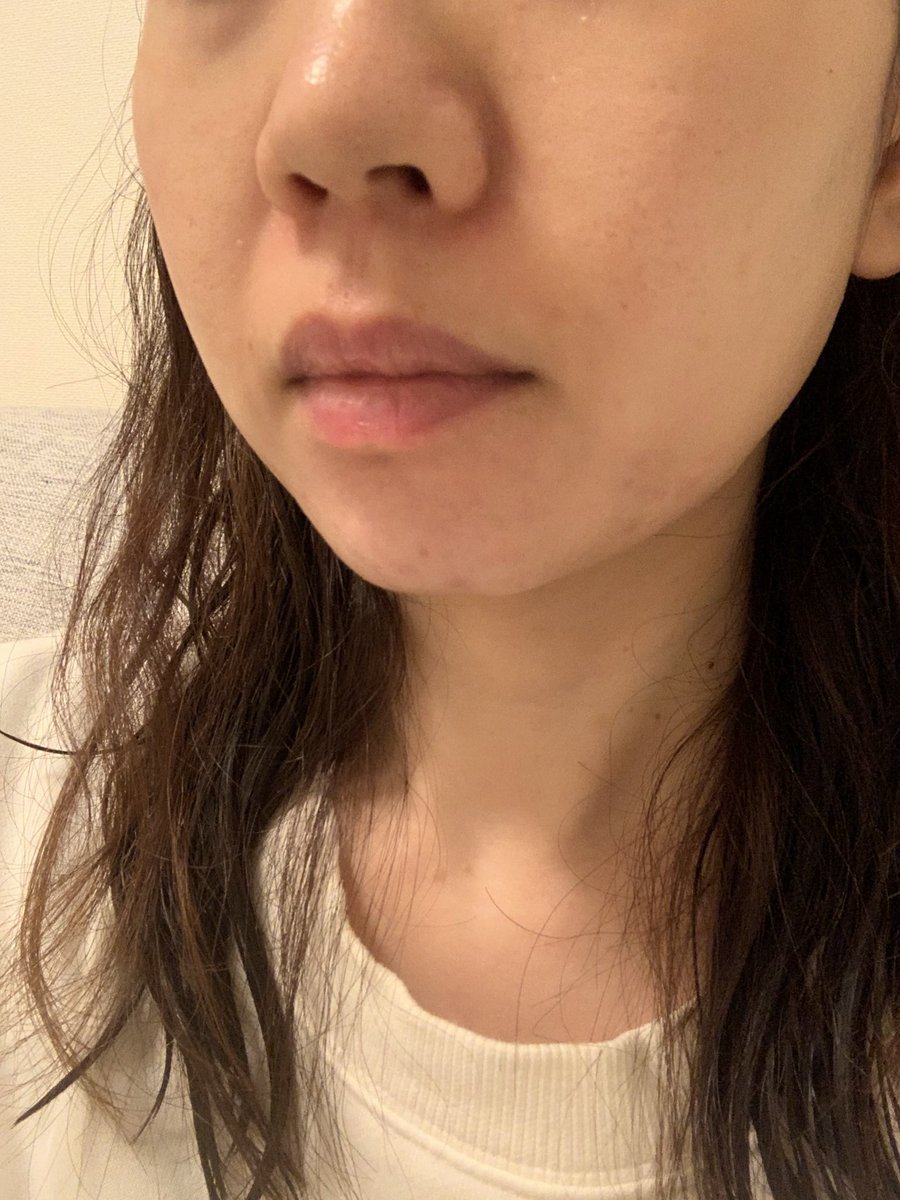 biyo_san's tweet photo. 【fatx coreのダウンタイム】
濃度が濃い分バチバチに腫れた記録

before https://t.co/admj8L5IEo