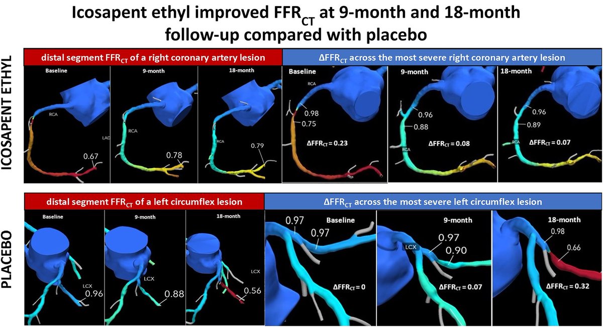 mperezg75's tweet photo. Benefit of icosapent ethyl on coronary physiology assessed by computed tomography angiography fractional flow reserve: #EVAPORATE-FFRCT 

European Heart Journal-Cardiovascular Imaging, jead063, https://t.co/YuZvn3DIg2

Published: 21 April 2023

💯 EPA
#Reduceit
#Icosapent ethyl https://t.co/ssfsKQ1csp