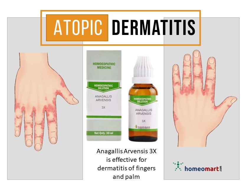 on Twitter "Atopic dermatitis is a common chronic skin