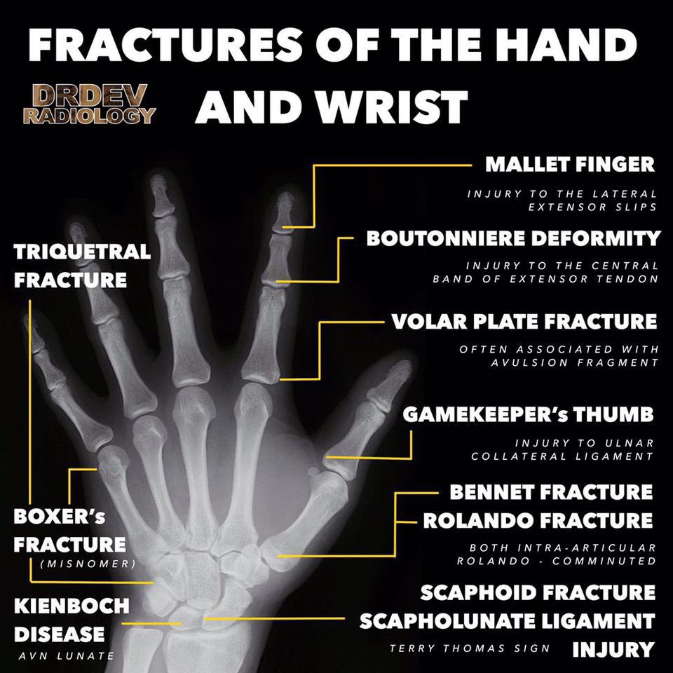 BrownJHM's tweet photo. Fractures of the hand &amp; wrist @drdevrad #FOAMed https://t.co/SCdYoKIPja