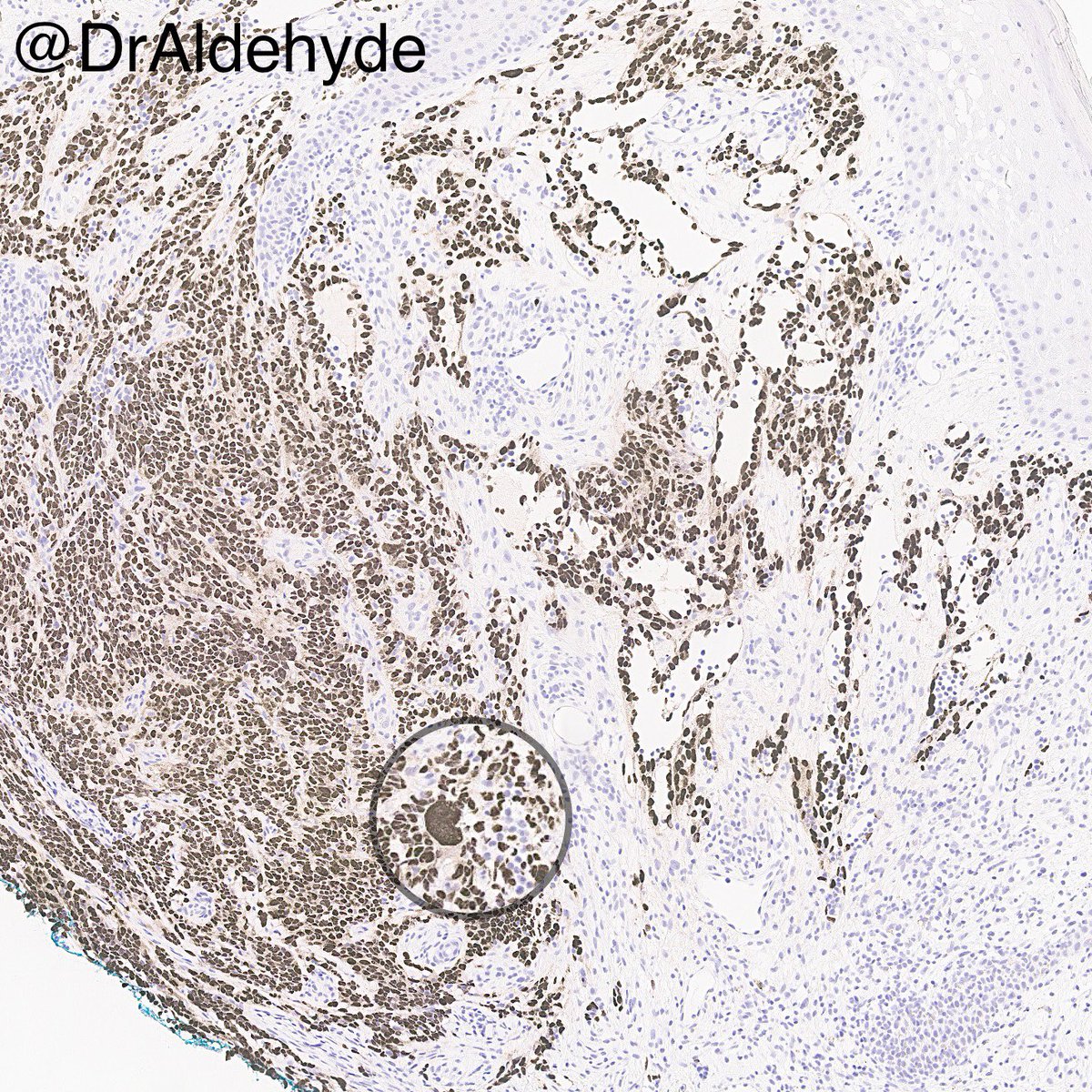 Here is another morphologic beauty I would like to share on Earth Day. 😆🔬🌎🌍🌏 I haven’t seen this kind of massive cells in this entity for a while (arrow). Can anybody guess what this #IHCPath might be? #pathology #dermpath