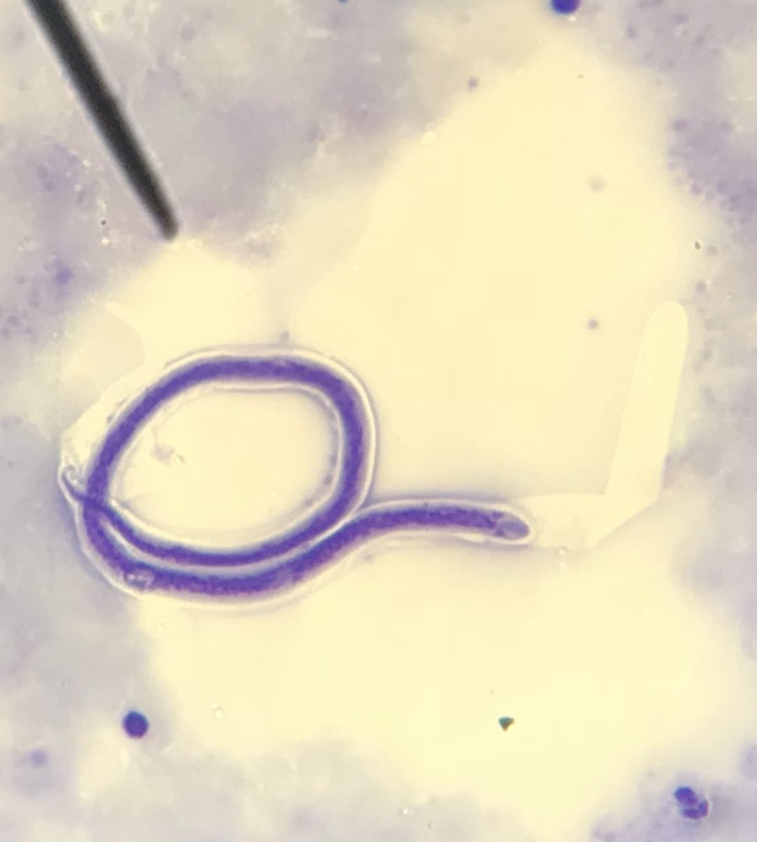 ชาวเมียนมาร์อายุ 30 ปี มาปรึกษาแพทย์ด้วยอาการขาบวม2ข้างมา 1 ปี ลักษณะบวมมาก กดไม่บุ๋ม ลักษณะดูคล้ายเท้าของช้าง ตรวจเลือดพบความผิดปกติดังแสดง
Blood smear: (thick film) พบ microfilaria ดังแสดง