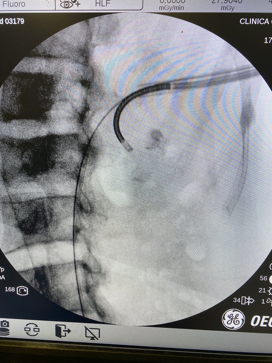 LuisLlanesGonz's tweet photo. Can we make an upper calyx puncture in #supineposition? Of course. Even #intercostal. A great approach to treat the stone in any location of the kidney. https://t.co/Q0s44kJUhp