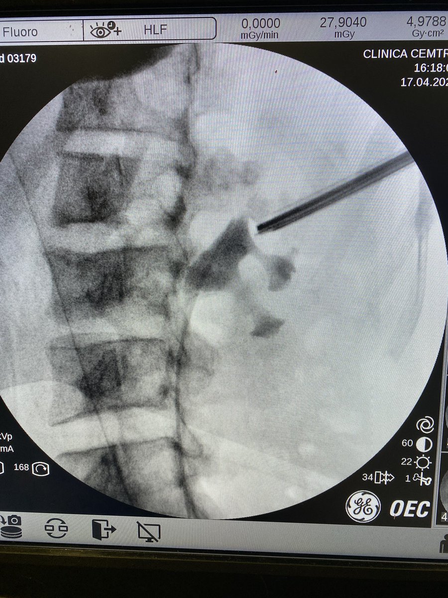 LuisLlanesGonz's tweet photo. Can we make an upper calyx puncture in #supineposition? Of course. Even #intercostal. A great approach to treat the stone in any location of the kidney. https://t.co/Q0s44kJUhp