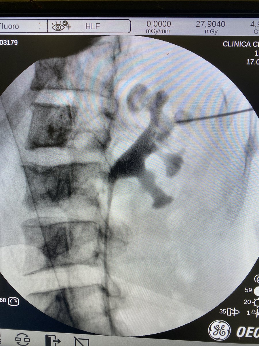 LuisLlanesGonz's tweet photo. Can we make an upper calyx puncture in #supineposition? Of course. Even #intercostal. A great approach to treat the stone in any location of the kidney. https://t.co/Q0s44kJUhp