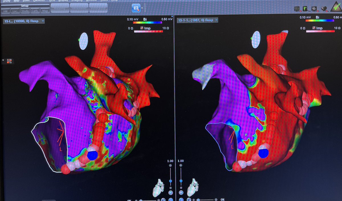 Extensive alc septal abl #HCM experience here but now working with #EPeeps on alc abl for #AF & #VT. Here’s our first VOM alc abl tag team procedure! @seiiwaiEPmd @DrRhthm We expect to be a dominant site. Send your complex refractory or persistent AF patients. @SCAI @HRSonline