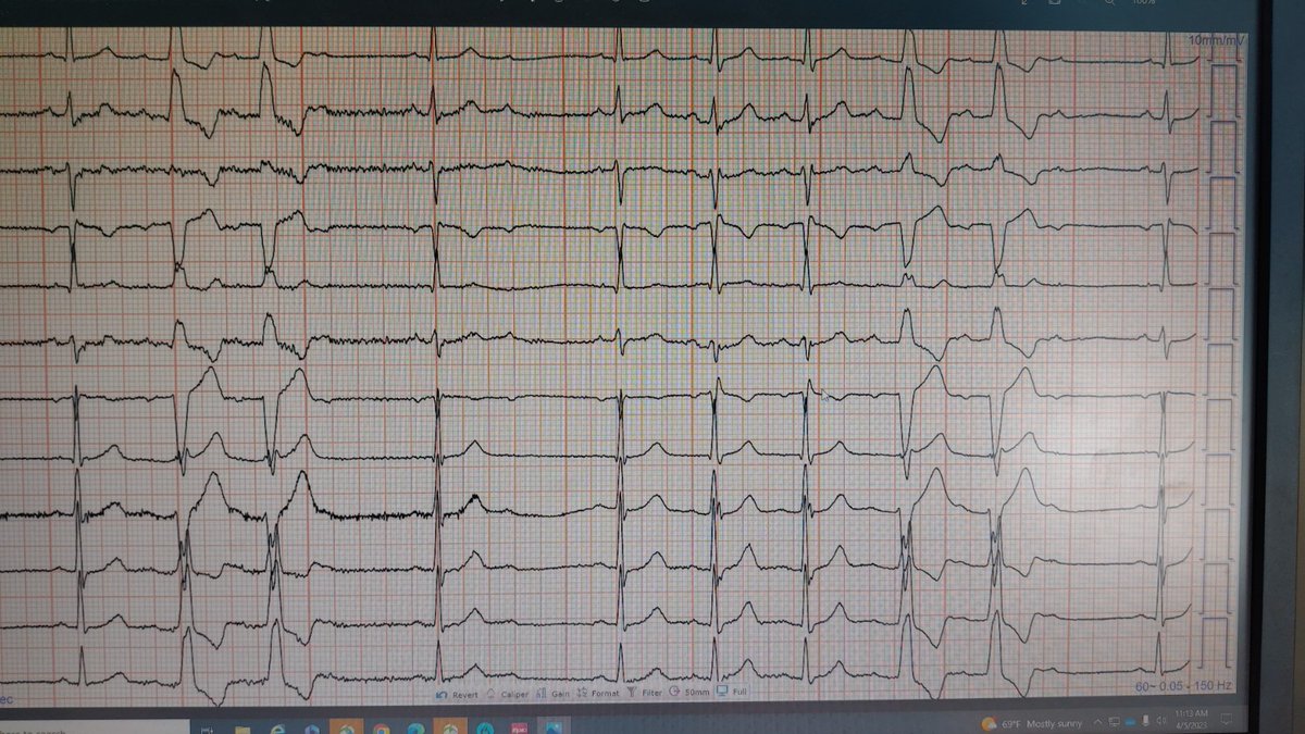 #EPeeps
Nice ECG 
What is going on ?