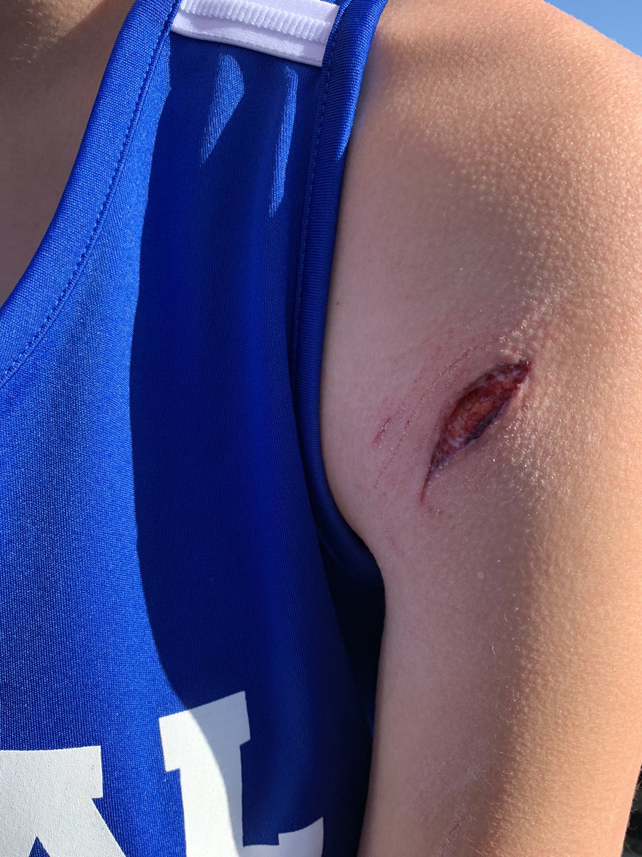 RuralXC's tweet photo. Look at this tough kid! Got tripped up and took a spike to the arm on the first lap of the 3200. Got up and not only finished the race, but set a PR running 11:57. Left the meet and got 9 stitches. @RuralTF https://t.co/GmtbvlonPJ