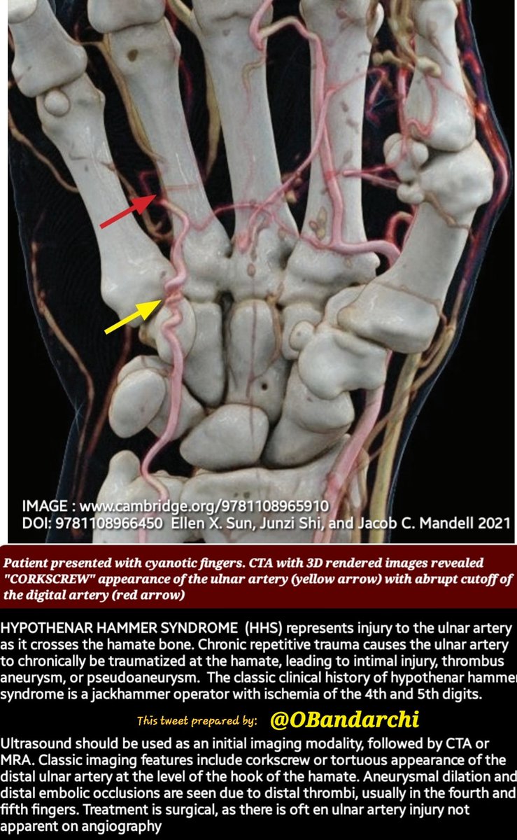 Dr.OMID BANDARCHI ,M.D. on Twitter "🛑Hypothenar hammer syndrome(HHS