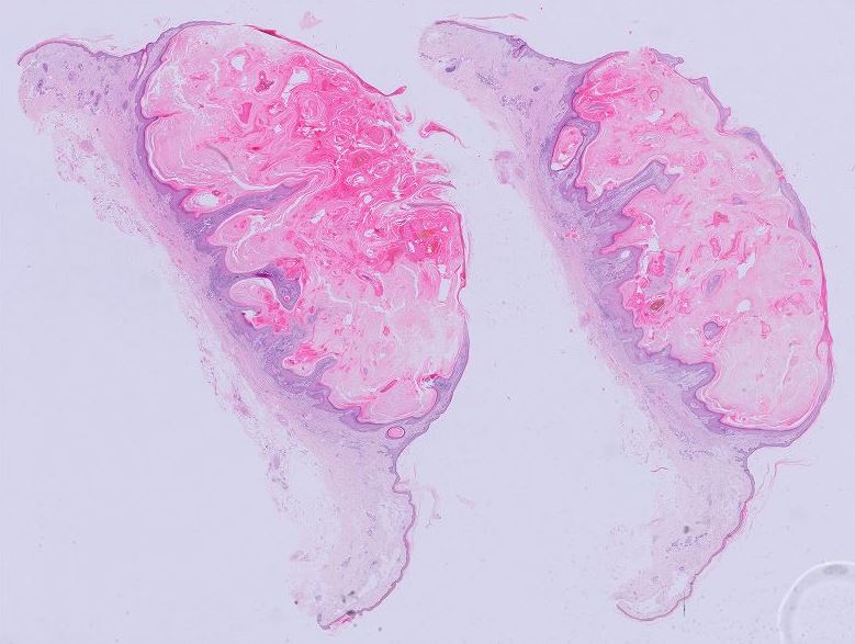 MBBS_Pathology's tweet image. #keratoacanthoma
#dermatology 
#pathology 
#dermpath 
💙💛