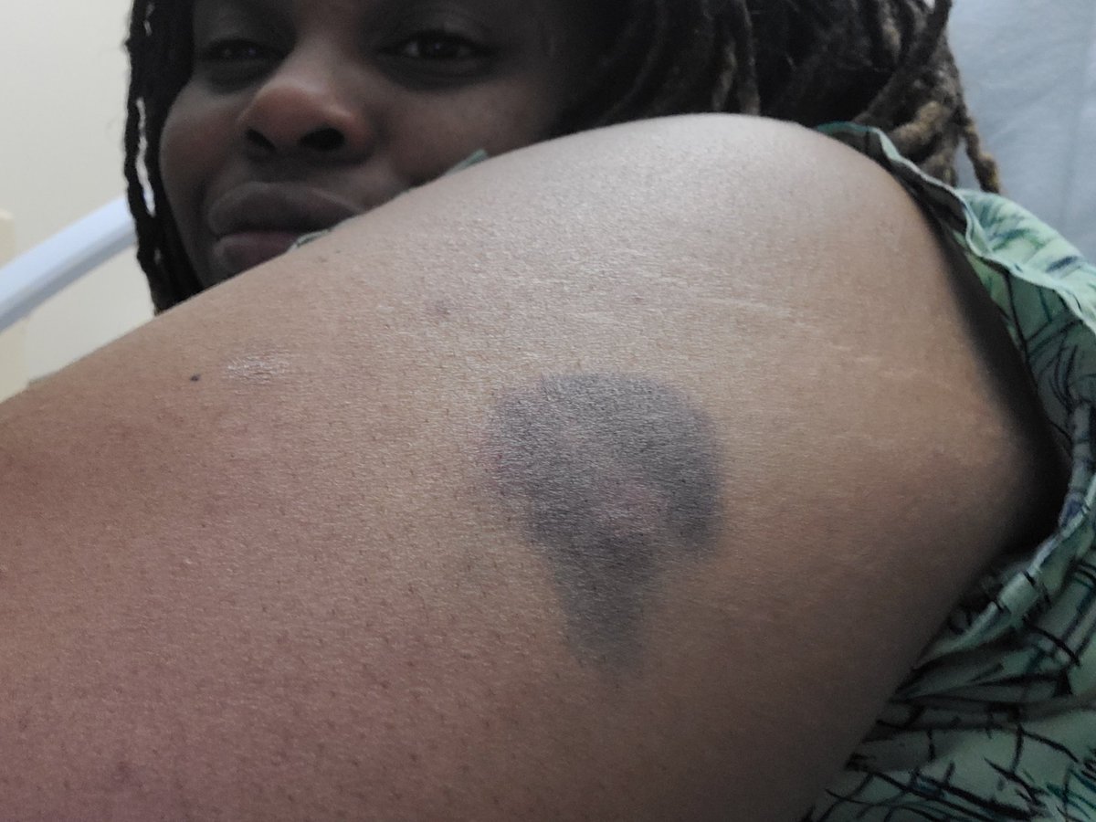 Shon61486281's tweet photo. @KUMedCenter  stabbed with lovanox shots. But since KHan I now am back to full inability to use my legs. Chronic pain all the time. Dr. Mullangi continually argued with me because she never listened always was emotional and forceful soI told her she needed someone to be with he. https://t.co/8q9ty0KoKy