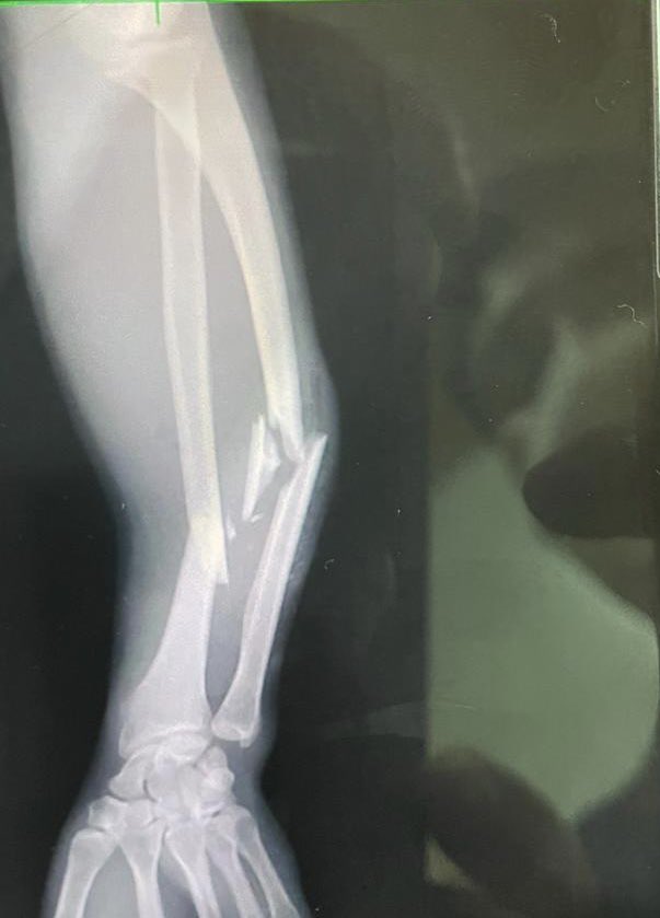 ral_acua's tweet photo. Hola gente! Hace 1 semana me chocaron y tengo una fractura en el brazo, debo ponerme platino y no logramos aún dar con el responsable y debo operarme lo antes posible! El próximo finde haré una actividad solidaria para recaudar fondos, desde ya agradezco la difusión! 🙏💪🏻🥹 https://t.co/UVnsSSOyE4