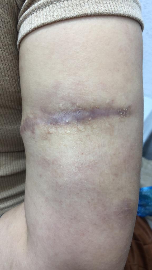 MasorTedavi's tweet photo. Dövme silme yara izi doğum çatlağı ciltteki lekeler Çiller kilo sonrası oluşan sarkmalar tek çözüm ağrısız acısız lekesiz cerahi operasyonsuz kurtulmuş oluyorsunuz artık yaşlılık yok ... https://t.co/hlw2KrEi9n