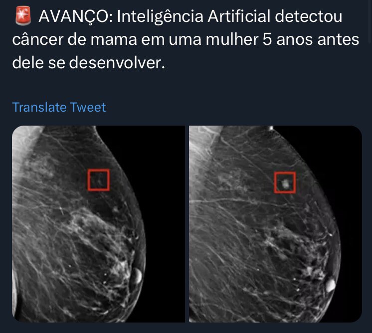 De tempos em tempos, notícias como essa aparecem e incendeiam um tema sempre polêmico: rastreamento de câncer. 🦀

Mas afinal, detectar um câncer precocemente tem benefícios?

E se tiver, os benefícios são maiores do que os riscos?

A leitura será extensa, mas necessária.👇🏻