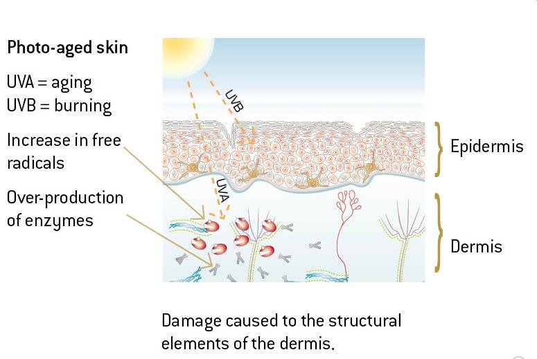 TheKoshurDoc's tweet photo. @OGdukeneurosurg @NEJM ◽️Unilateral Dermatoheliosis

▫️Dermatoheliosis : all changes to skin due to sun exposure

- Epidermis: Actinic keratosis
- Dermis: Solar elastosis
- Blood vessels: Telangiectasia
- Sebaceous glands: Solar comedones
- Melanocytes: Dffuse or mottled brown patches

@IhabFathiSulima https://t.co/3m49IrsoM8
