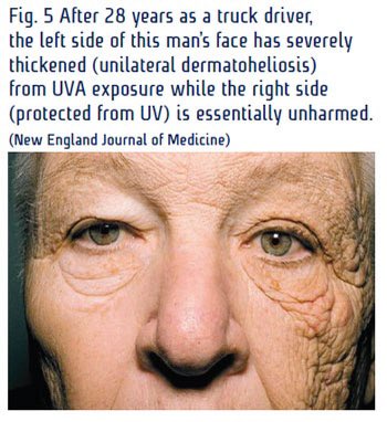 TheKoshurDoc's tweet photo. @OGdukeneurosurg @NEJM ◽️Unilateral Dermatoheliosis

▫️Dermatoheliosis : all changes to skin due to sun exposure

- Epidermis: Actinic keratosis
- Dermis: Solar elastosis
- Blood vessels: Telangiectasia
- Sebaceous glands: Solar comedones
- Melanocytes: Dffuse or mottled brown patches

@IhabFathiSulima https://t.co/3m49IrsoM8