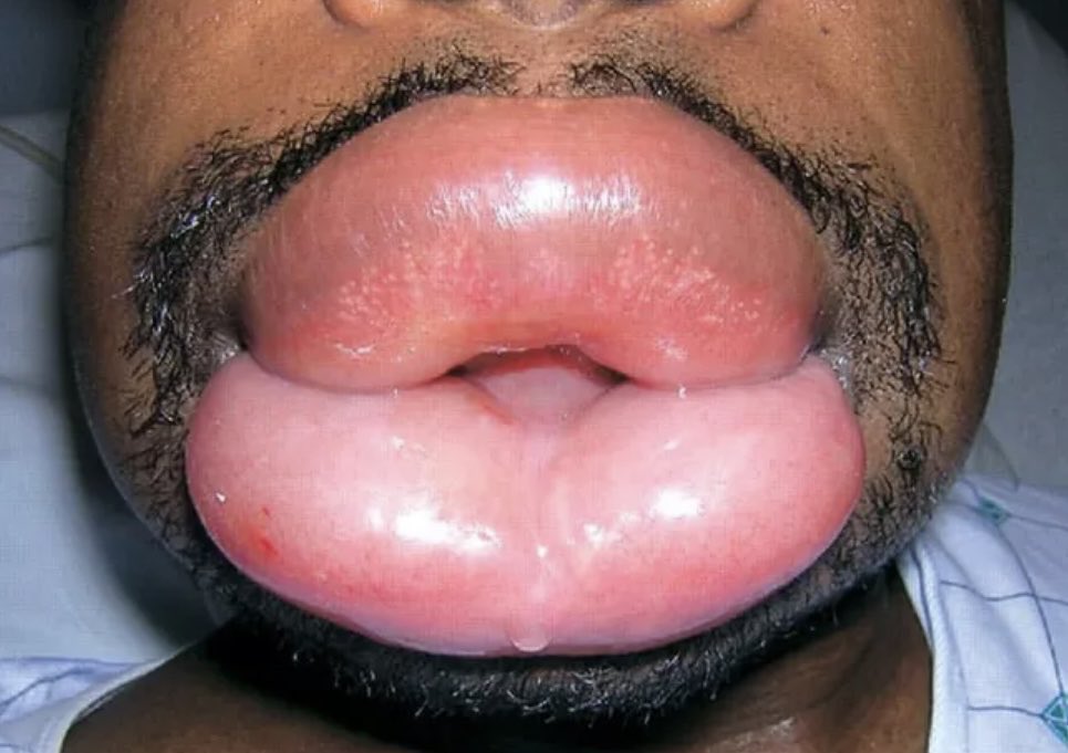Angioedema (not an agressive aesthetic injector)… tell me about it.