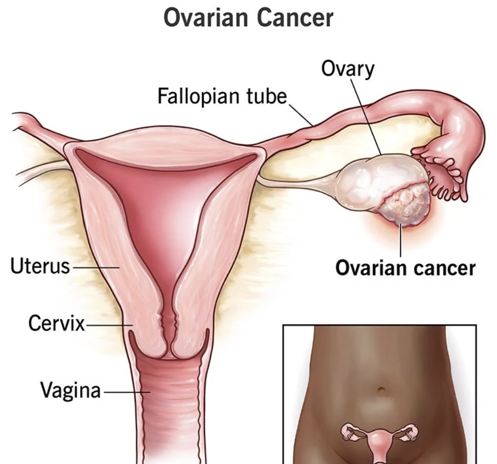 drkohilathas's tweet photo. Mushrooms that have shown specific anti-ovarian cancer activity.       

A THREAD 🧵 https://t.co/mr7EBf3y1j