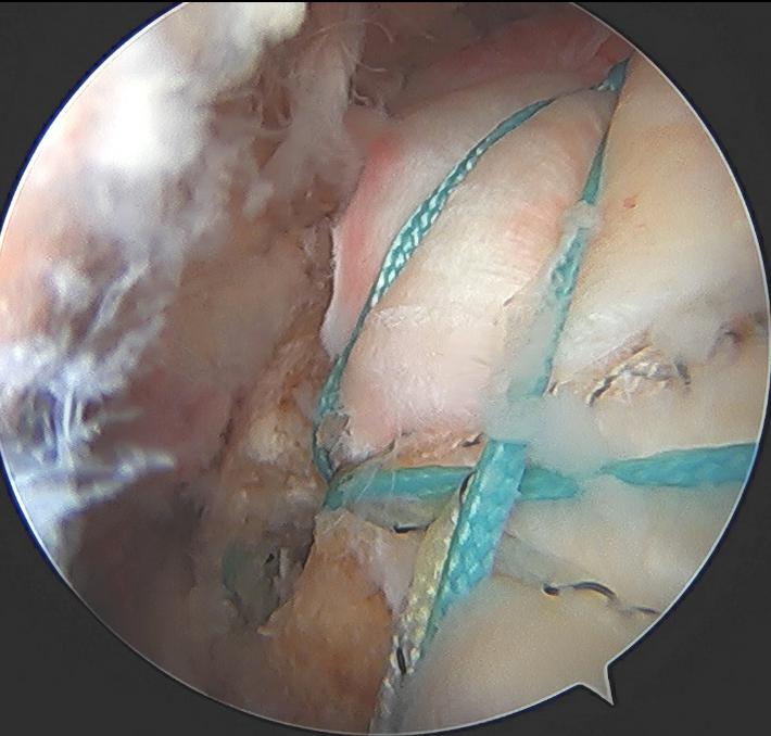DrNickColyvas's tweet photo. 9 months. Very happy
#rotatorcuffrepair
#doublerow https://t.co/a83zkmplHZ