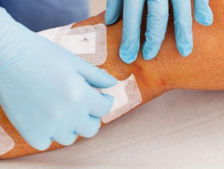 19patchant's tweet photo. #infirmiersliberauxencolere @FrcsBraun @agnesfirmin   Aujourd’hui pst de varices avec ablation de points. . Points serrés , hématome , œdèmes , bref un pansement simple côté 9,45 brut pour 45 minutes  . Quand est ce que vous allez réagir !!! Une infirmière qui n en peut plus ! https://t.co/sWNNP5MQVk