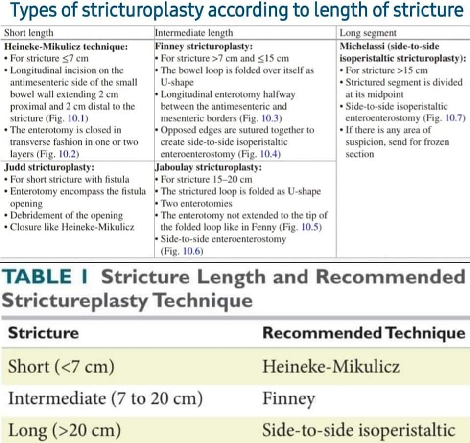 DRAFTABAHMED7's tweet photo. Types of stricturoplasty according to length of stricture
🅐︎Heineke-Mikulicz technique
🅑︎Finney stricturoplasty
🅒︎Jaboulay stricturoplasty
🅓︎Michelassi(side-to-side 
isoperistaltic stricturoplasty)
🅔︎Judd stricturoplasty
Ref: A Guidance to Pass the Board Clinical Exam. https://t.co/f5QjnDfhqJ