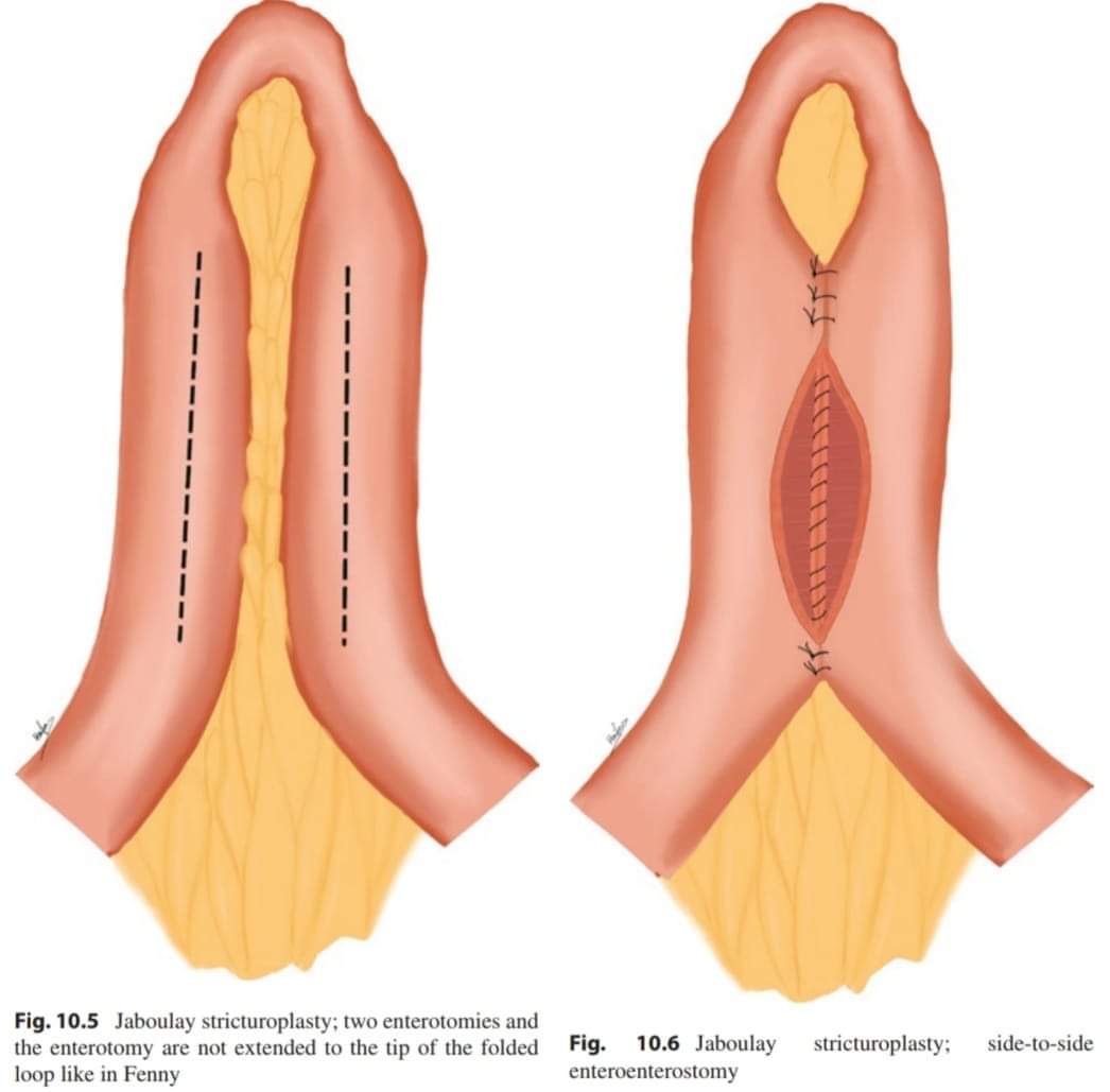 DRAFTABAHMED7's tweet photo. Types of stricturoplasty according to length of stricture
🅐︎Heineke-Mikulicz technique
🅑︎Finney stricturoplasty
🅒︎Jaboulay stricturoplasty
🅓︎Michelassi(side-to-side 
isoperistaltic stricturoplasty)
🅔︎Judd stricturoplasty
Ref: A Guidance to Pass the Board Clinical Exam. https://t.co/f5QjnDfhqJ