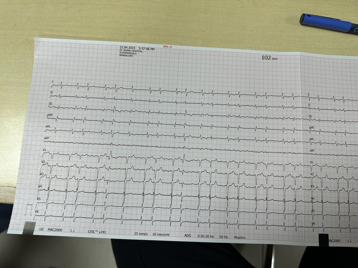 Santhrupth22's tweet photo. 70Y/M, Left lower limb cellulitis with septic shock, intubated with low gcs, i have a confusion with this ECG, 2nd Hb mobitz 2 vs atrial flutter with variable block ?
@DidlakeDW @EcgOxford @ecgrhythms @EM_RESUS @Jagdish26039718 @The_Nanashi_O @EKGest @BrooksWalsh @GangoliBorun https://t.co/cN0DTVhXPt