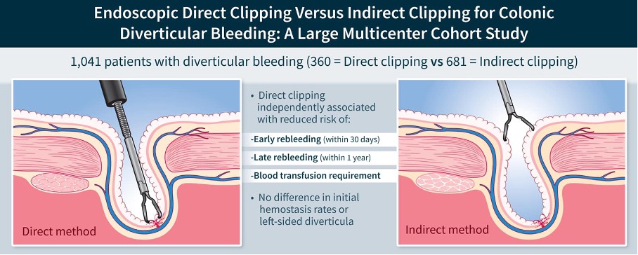 #UEGJFridays answer:
🩸 Direct vessel clipping is superior to indirect clipping for colonic #diverticular #bleeding
🩸 overall #LGIB incidence is 33-87/ 100 000

📕 More info about article in @UEGJournal 
👇
is.gd/CkrAj8

@my_ueg @AntheaPisani @AnaDugic @KralJan #MedEd