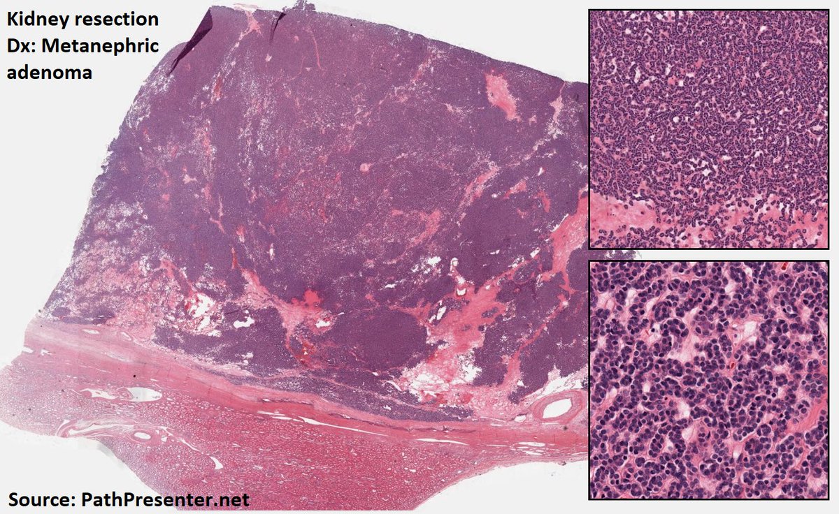 DrTravisBrown's tweet photo. Histology flash card

Kidney: Metanephric adenoma

Rare (<0.5% renal neoplasms)
Oft incidental finding

Benign
Usually single focus &amp; unilateral
Av 3-6cm diameter

Histo
Cellular blue tumour
Tightly packed tubules
Scant cytoplasm

Majority BRAF mutation +ve

#PathTwitter https://t.co/5AvGvfGYKh