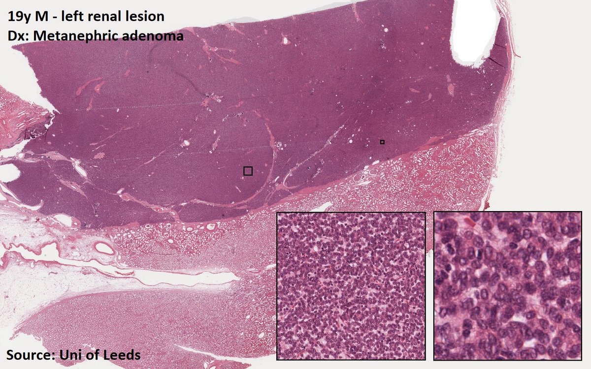DrTravisBrown's tweet photo. Histology flash card

Kidney: Metanephric adenoma

Rare (<0.5% renal neoplasms)
Oft incidental finding

Benign
Usually single focus &amp; unilateral
Av 3-6cm diameter

Histo
Cellular blue tumour
Tightly packed tubules
Scant cytoplasm

Majority BRAF mutation +ve

#PathTwitter https://t.co/5AvGvfGYKh