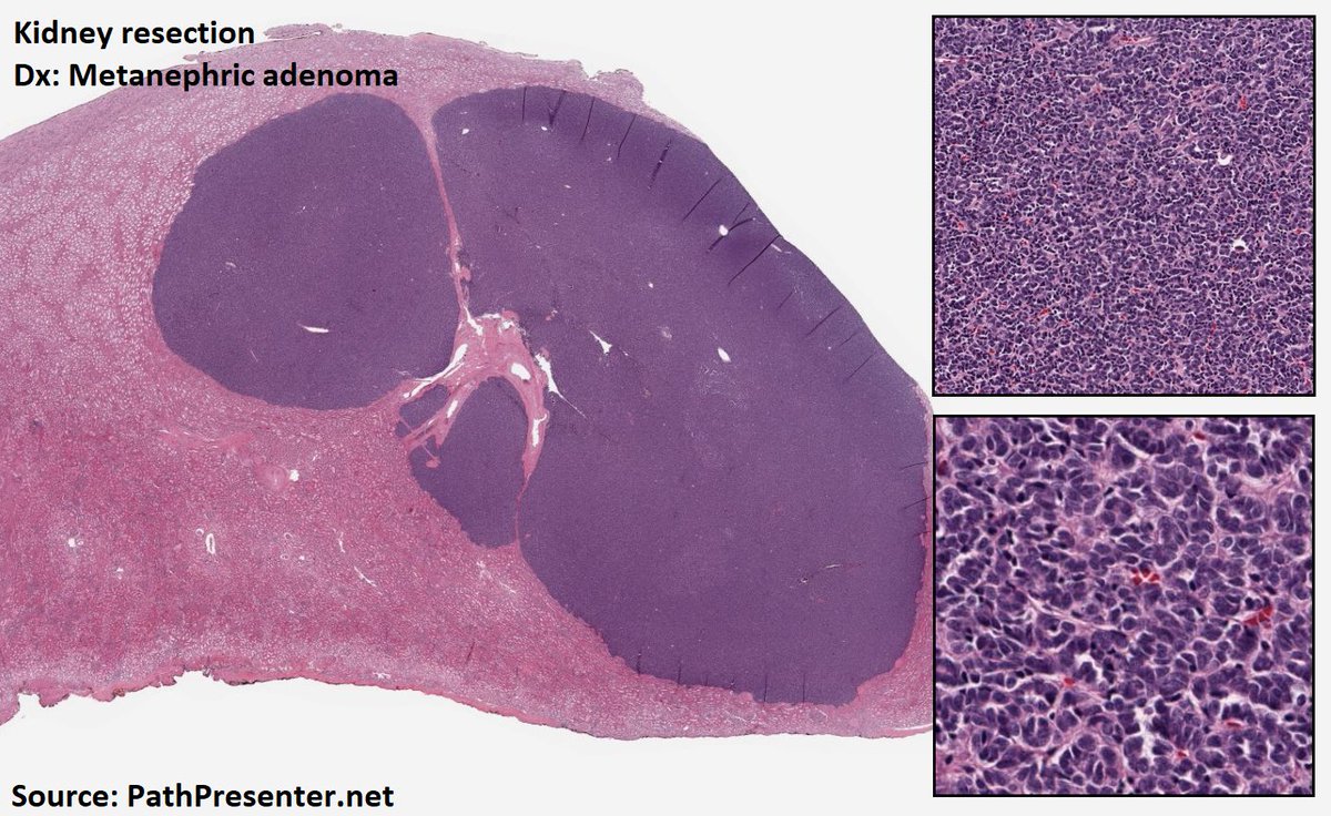 DrTravisBrown's tweet photo. Histology flash card

Kidney: Metanephric adenoma

Rare (<0.5% renal neoplasms)
Oft incidental finding

Benign
Usually single focus &amp; unilateral
Av 3-6cm diameter

Histo
Cellular blue tumour
Tightly packed tubules
Scant cytoplasm

Majority BRAF mutation +ve

#PathTwitter https://t.co/5AvGvfGYKh