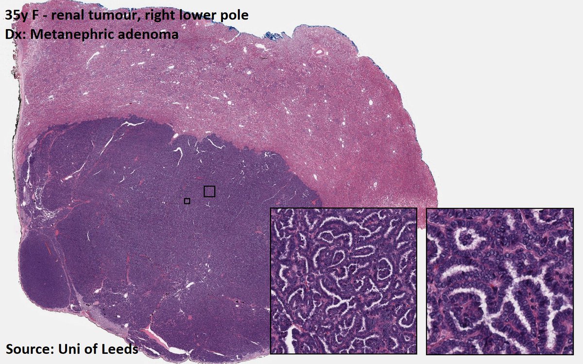 DrTravisBrown's tweet photo. Histology flash card

Kidney: Metanephric adenoma

Rare (<0.5% renal neoplasms)
Oft incidental finding

Benign
Usually single focus &amp; unilateral
Av 3-6cm diameter

Histo
Cellular blue tumour
Tightly packed tubules
Scant cytoplasm

Majority BRAF mutation +ve

#PathTwitter https://t.co/5AvGvfGYKh