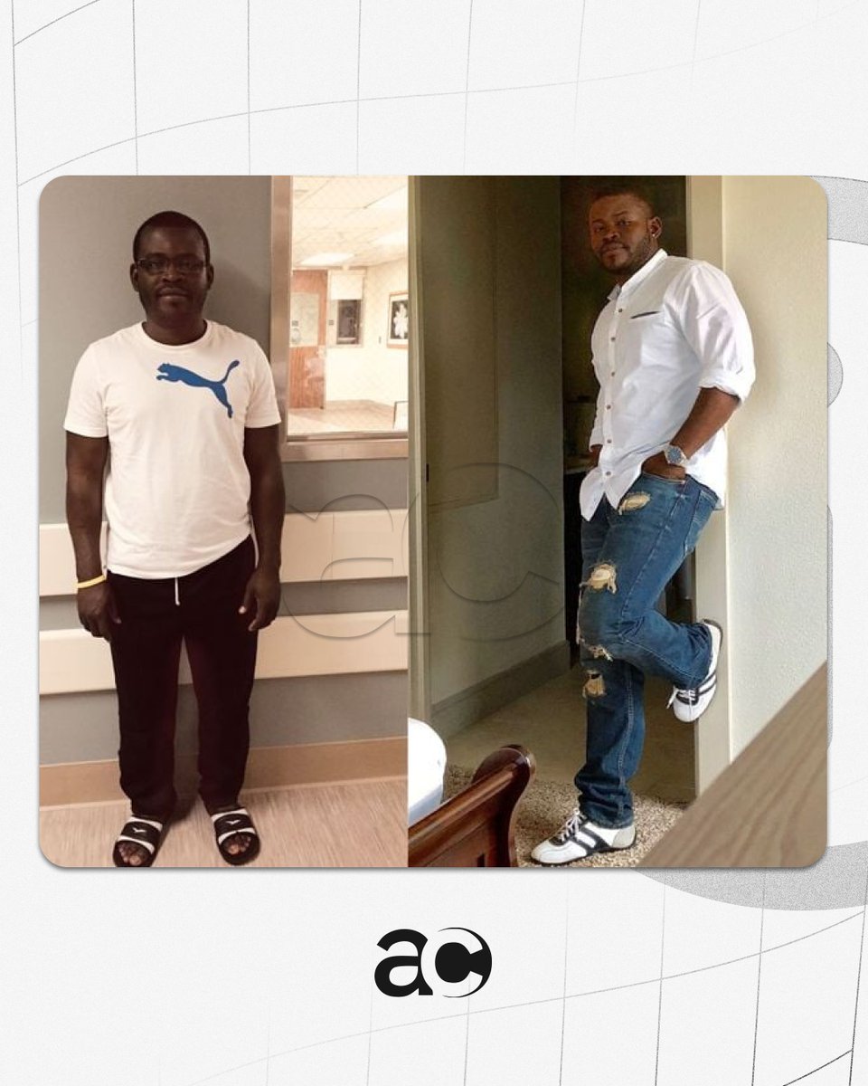 AcervoCharts's tweet photo. 🚨 EITA: Homem passa por cirurgia que envolveu a quebra dos ossos das pernas para aumentar a altura, a estatura do jovem foi de 1,65 para 1,78.

“Agora tenho uma namorada. Valeu a pena!” https://t.co/EmMEKSbIE6