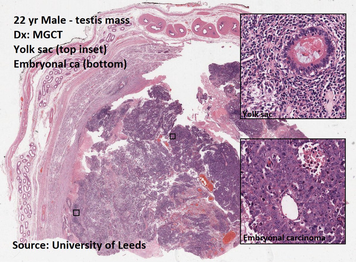 DrTravisBrown's tweet image. Histology flash card

Testis: Germ cell tumours (GCT)

95% all testicular tumours
Peak age 30 yrs (range 20-50)

Oft slow growing painless mass
1-2% bilateral (oft classical seminoma)

Histo
60% Mixed GCT

Prognosis ➡️ morphology dependent
p53 mut common

#PathTwitter