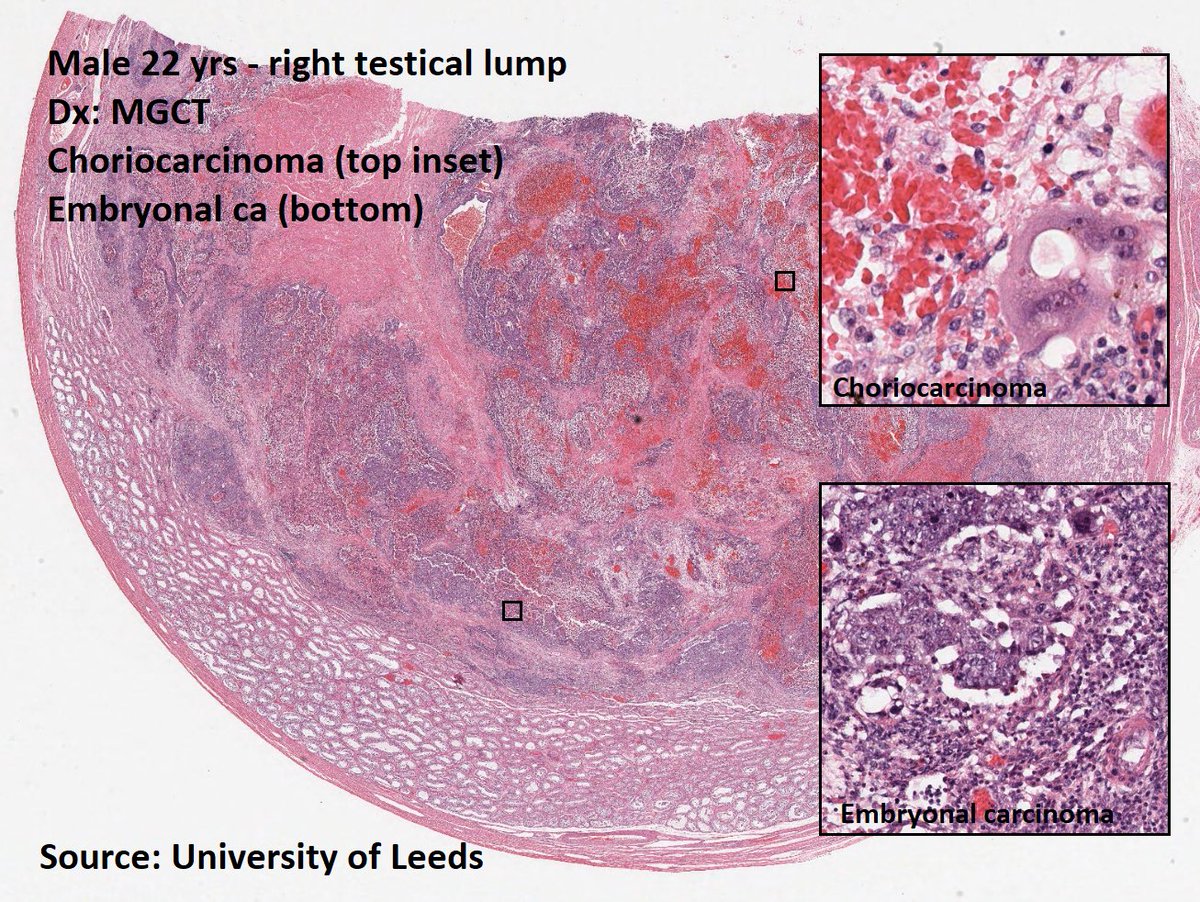 DrTravisBrown's tweet image. Histology flash card

Testis: Germ cell tumours (GCT)

95% all testicular tumours
Peak age 30 yrs (range 20-50)

Oft slow growing painless mass
1-2% bilateral (oft classical seminoma)

Histo
60% Mixed GCT

Prognosis ➡️ morphology dependent
p53 mut common

#PathTwitter