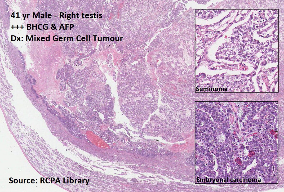 DrTravisBrown's tweet image. Histology flash card

Testis: Germ cell tumours (GCT)

95% all testicular tumours
Peak age 30 yrs (range 20-50)

Oft slow growing painless mass
1-2% bilateral (oft classical seminoma)

Histo
60% Mixed GCT

Prognosis ➡️ morphology dependent
p53 mut common

#PathTwitter