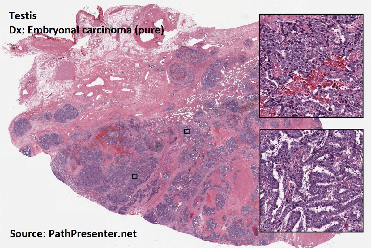 DrTravisBrown's tweet image. Histology flash card

Testis: Germ cell tumours (GCT)

95% all testicular tumours
Peak age 30 yrs (range 20-50)

Oft slow growing painless mass
1-2% bilateral (oft classical seminoma)

Histo
60% Mixed GCT

Prognosis ➡️ morphology dependent
p53 mut common

#PathTwitter